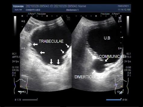 pathophysiology of trabeculation